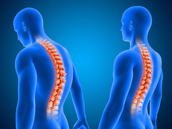 قوز کمر چیست و چگونه آن را از بین ببریم؟ قوز کمر چیست و چگونه آن را از بین ببریم؟